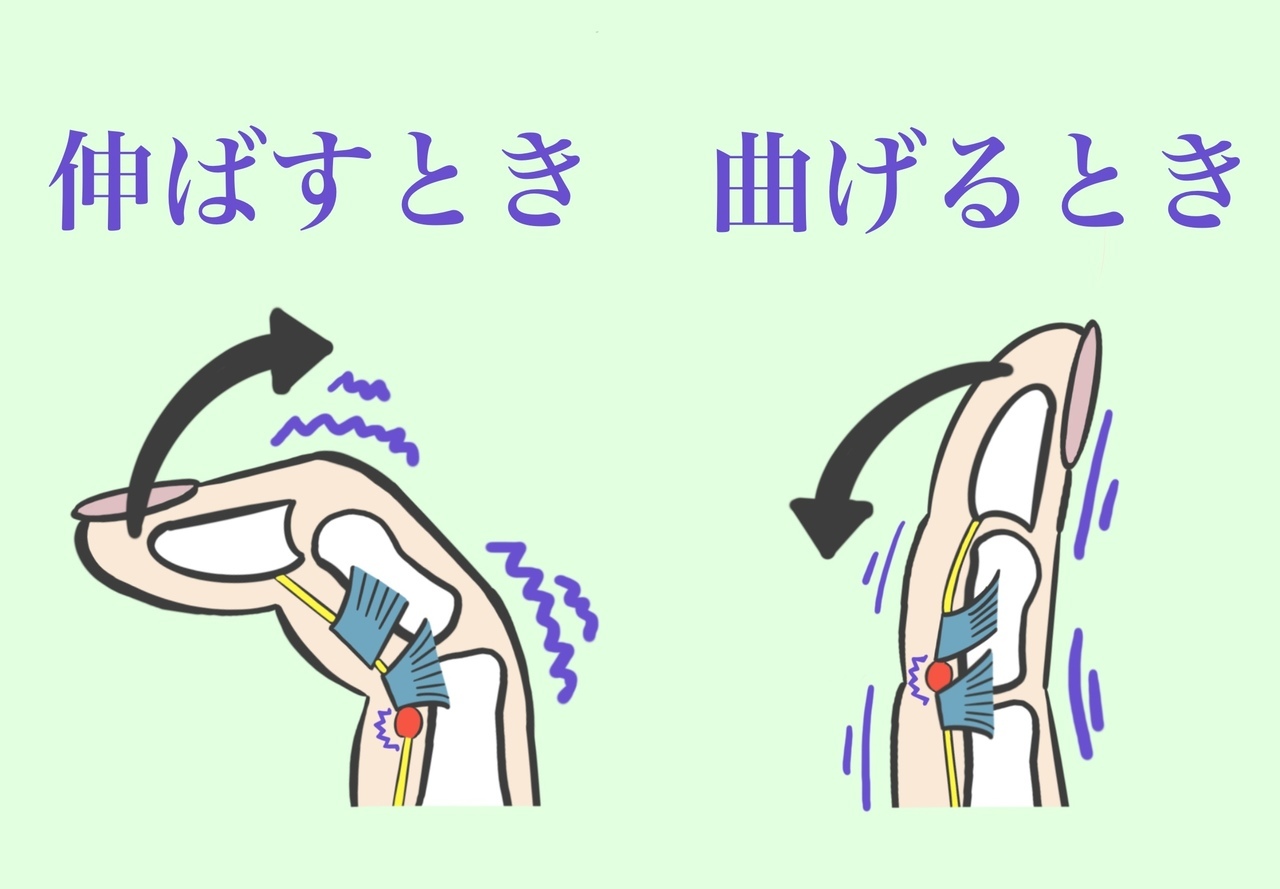 ばね指の仕組みイメージ