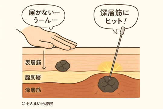 深層筋に届く鍼灸